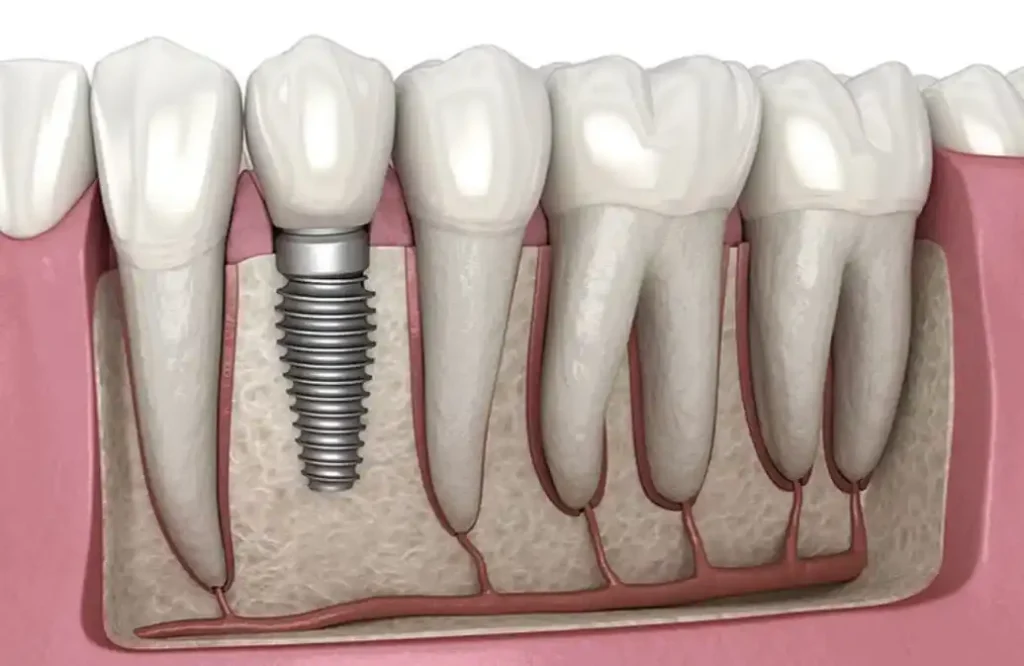 Dental Implants in Richmond Hill Dental